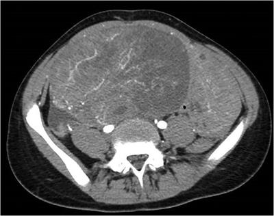 Case report: Primary ovarian Burkitt's lymphoma: A puzzling scenario in pediatric population